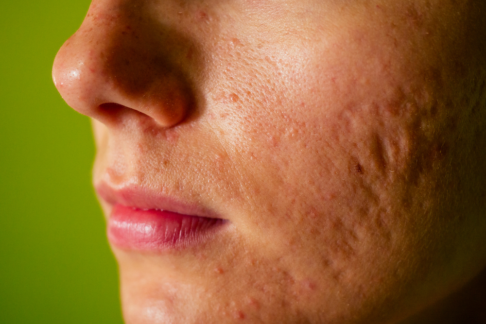 Close up photo of a woman's acne scars before receiving Topical Peptide and Topical Stem Cell Therapy in Troy, MI