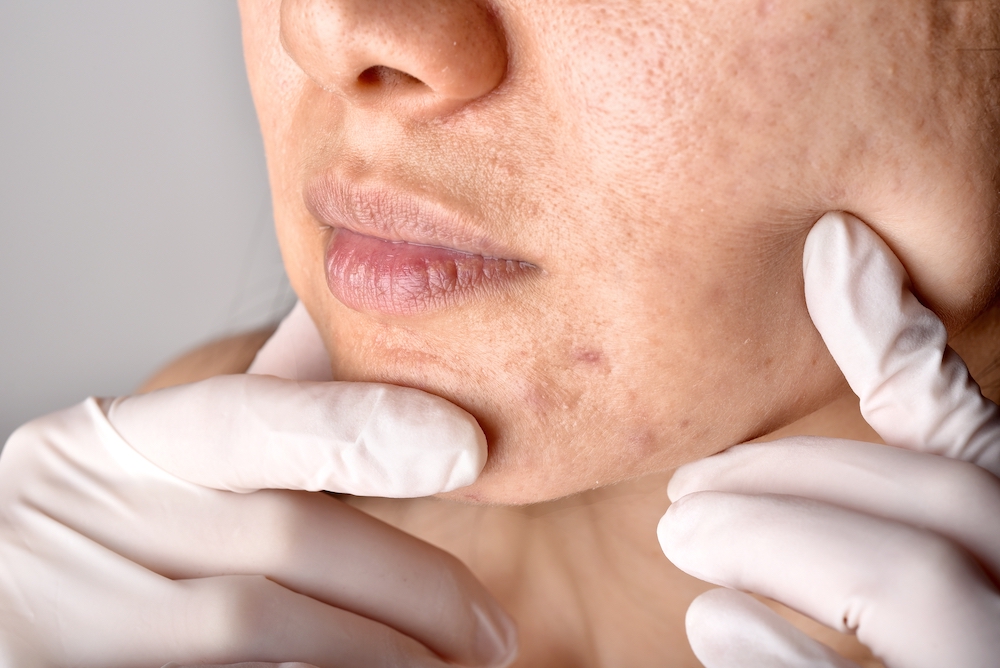 A woman examines blemishes on her skin before receiving topical peptide and topical stem cell therapy in Troy, MI