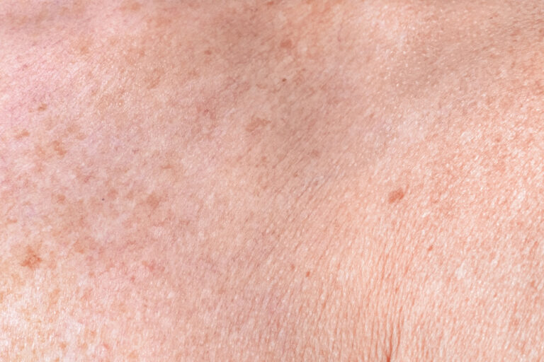 close up of skin with melasma spots