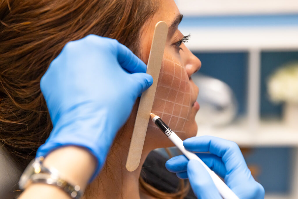 An example of the grid our injectors use to precisely plot and inject our dermal fillers near Shelby Township.