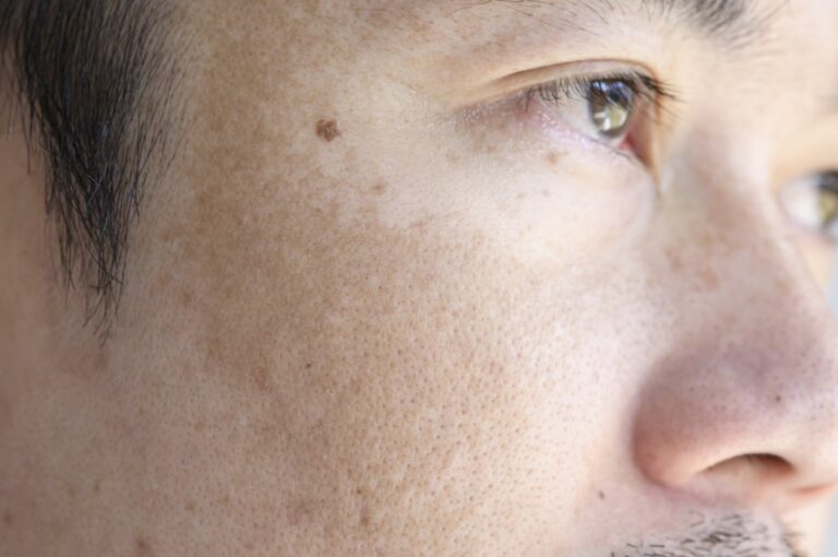 Close up of an Asian man's face with freckles and dark spots from sun damage near Macomb, MI.
